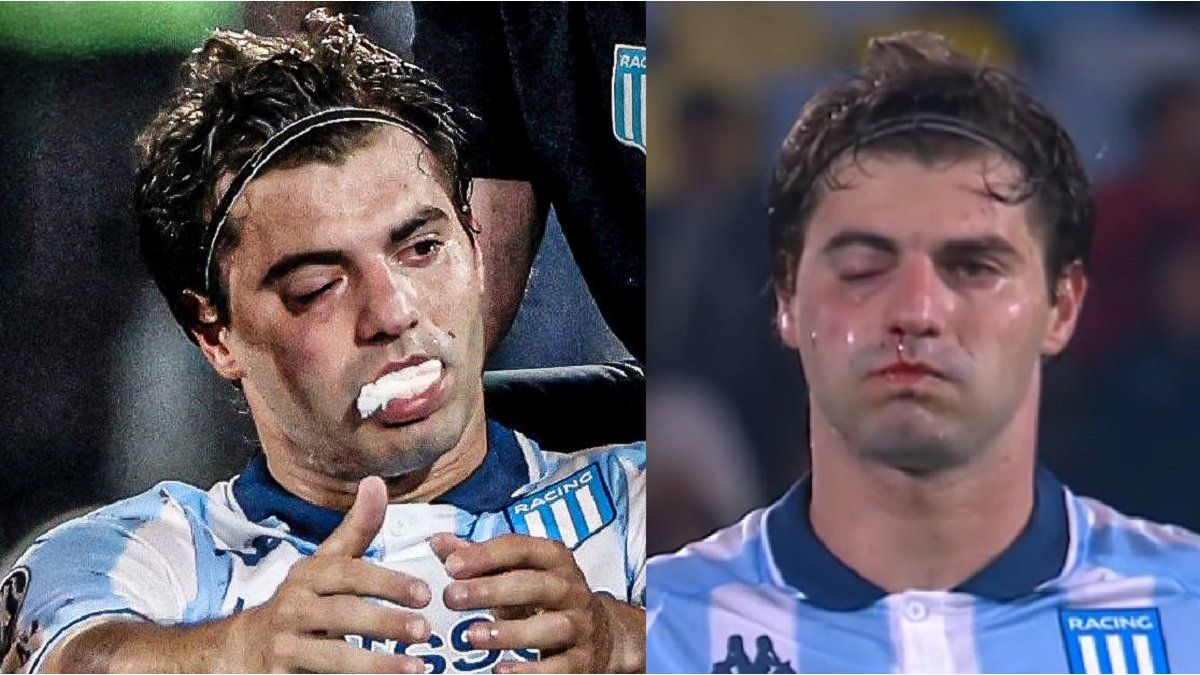Santiago Sosa tiene fractura de maxilar por el golpe de Marcos Rojo y es duda para la revancha ante Flamengo