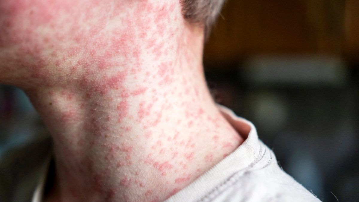 Buenos Aires declaró extinto el brote de sarampión tras 20 semanas sin nuevos casos