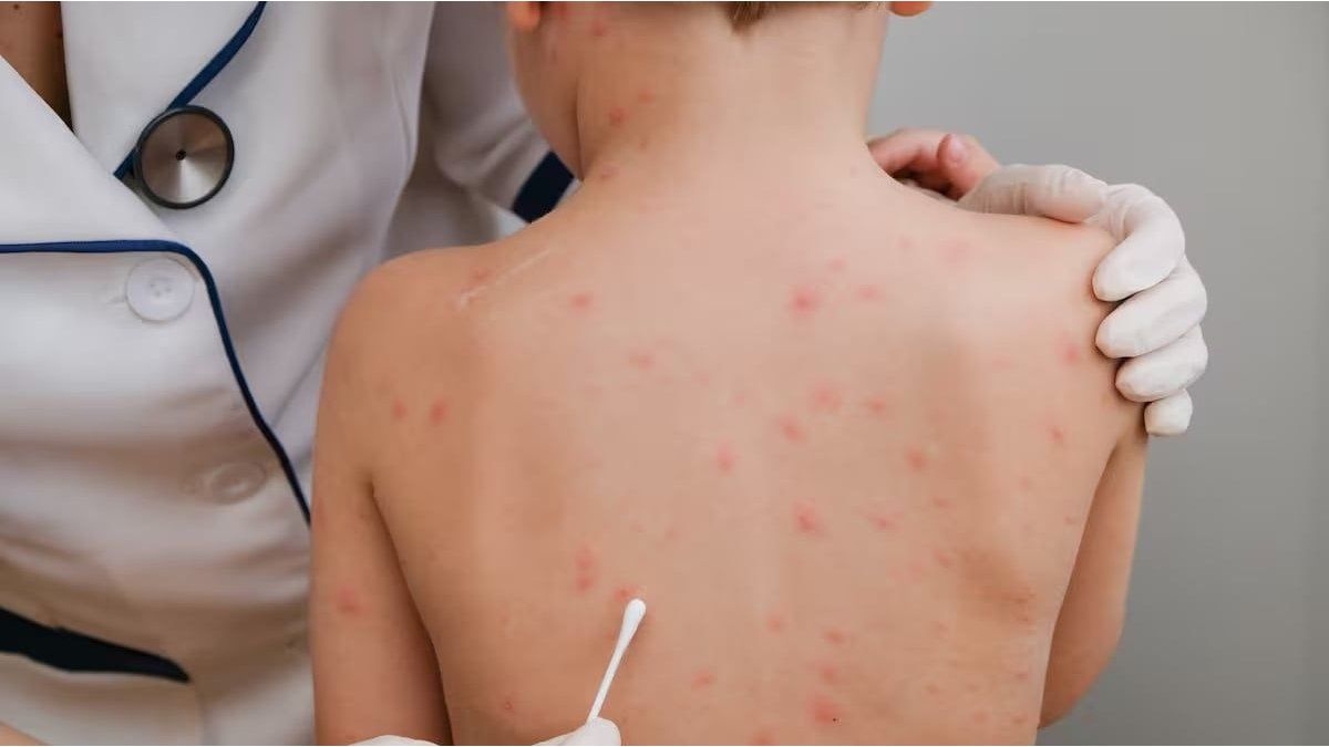 Con críticas a Nación, Provincia alerta por avance de otro brote de sarampión