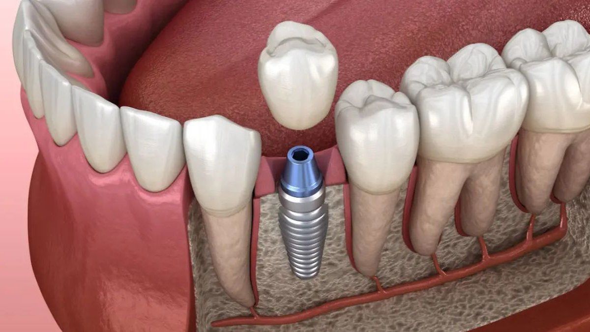Cuáles son los riesgos y complicaciones de los implantes dentales, según los especialistas