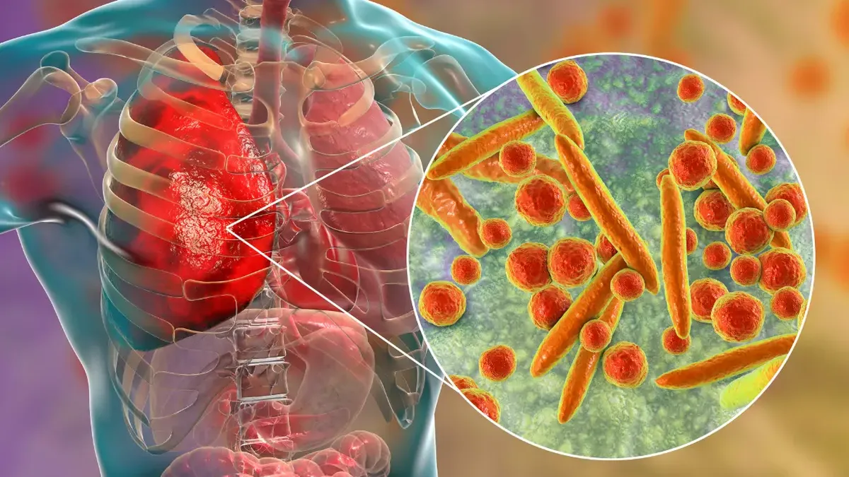 científicos revelaron el impacto de la higiene bucal en la prevención de la neumonía